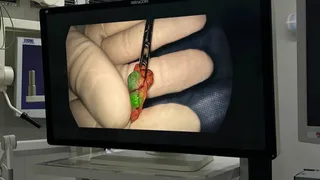Хирурги Удмуртии тестируют новую технологию